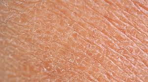 Understanding Dry Skin: Causes, Symptoms, and Treatment